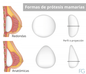 Prótesis mamarias redondas y anatómicas.