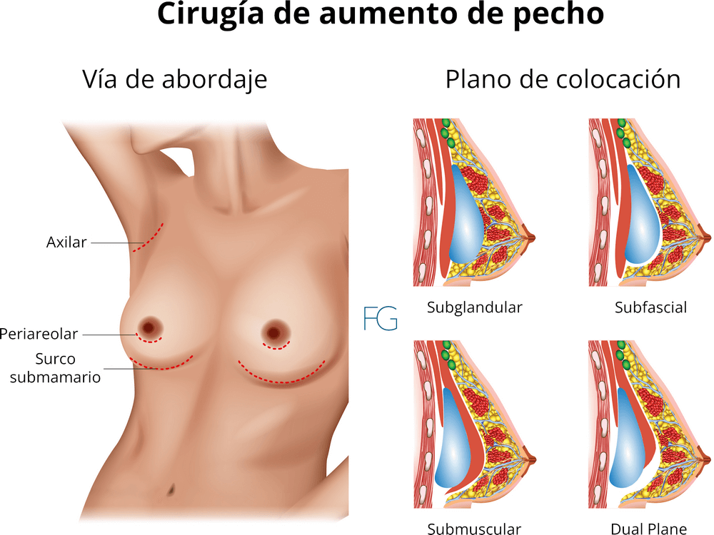Tipos de cirugía de aumento de pecho que realiza el Doctor Franco Góngora en Madrid con prótesis