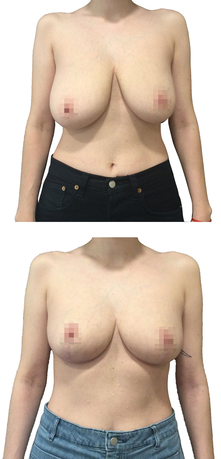 Reducción mamaria antes y después en paciente del Doctor Franco Góngora en la ciudad de Madrid