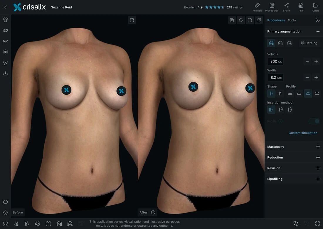Imagen simulación Crisalix en aumento de pecho